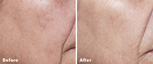 ANTEAGE Home Microneedling Solution Kit